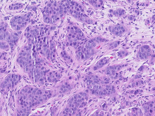 Figure 2. A close up in high resolution from Figure 1; an example from case 11 in this dataset, here showing an area of interest for atypia and mitosis from the preoperative sample (biopsy).